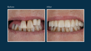 Before and after dental implant treatment results showing restored smile at North Down Dental in Bangor, Northern Ireland.