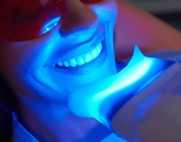 North Down Dental Bangor Northern Ireland, using Teeth Whitening products.