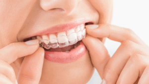 Woman wearing orthodontic retainer, with Boutique Whitening gel 