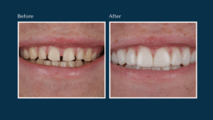 Before and after Composite Bonding treatment results showing restored smile at North Down Dental in Bangor, Northern Ireland.
