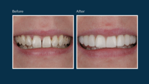 Before and after Composite Veneers treatment results showing restored smile at North Down Dental in Bangor, Northern Ireland.
