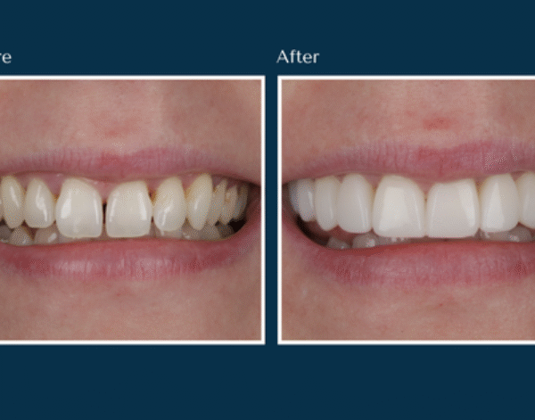 Before and after Composite Veneers treatment results showing restored smile at North Down Dental in Bangor, Northern Ireland.