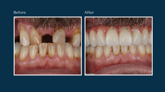 A before and after of a dental patient who received dental implants at North Down Dental & Implant Clinic in Bangor, Northern Ireland.
