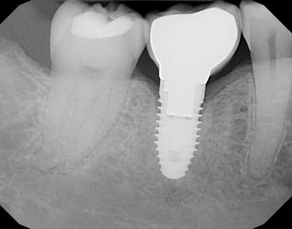 Image of a dental implant fitted by North Down Dental in Bangor, Northern Ireland.