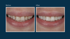 Before and after on a composite bonding patient at North Down Dental in Bangor, Northern Ireland.