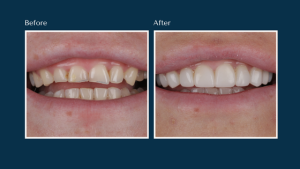 Before and after on a composite bonding patient at North Down Dental in Bangor, Northern Ireland.