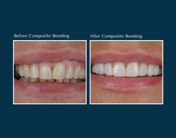 Composite bonding before and after at North Down Dental