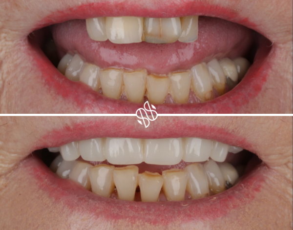 Tooth replacement treatment at North Down Dental in Bangor, Northern Ireland.